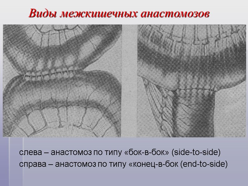Виды межкишечных анастомозов слева – анастомоз по типу «бок-в-бок» (side-to-side) справа – анастомоз по